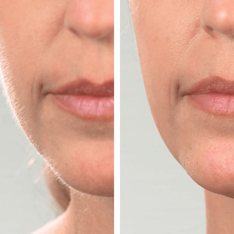 Olura™ Facial Epilator