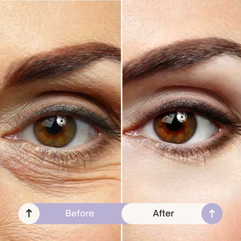 NanoGlow - #1 Microneedle Eye Patches to Reduce Eye Bags & Dark Circles