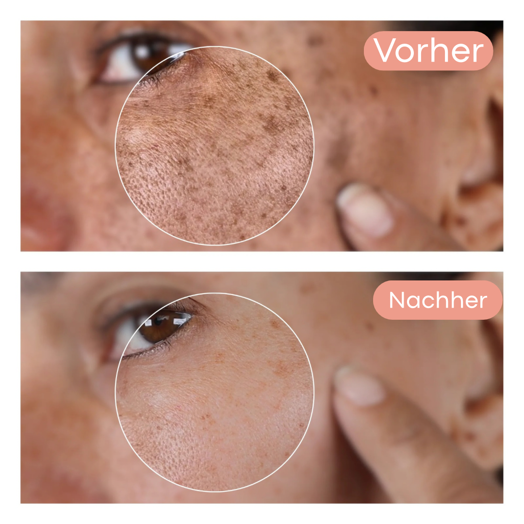 Olura Dark Spot Corrector | 1+1 GRATIS