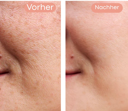 Olura Dark Spot Corrector | 1+1 GRATIS